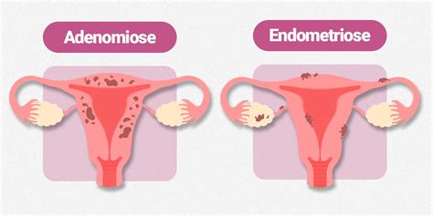 adenomiose uterina e endometriose